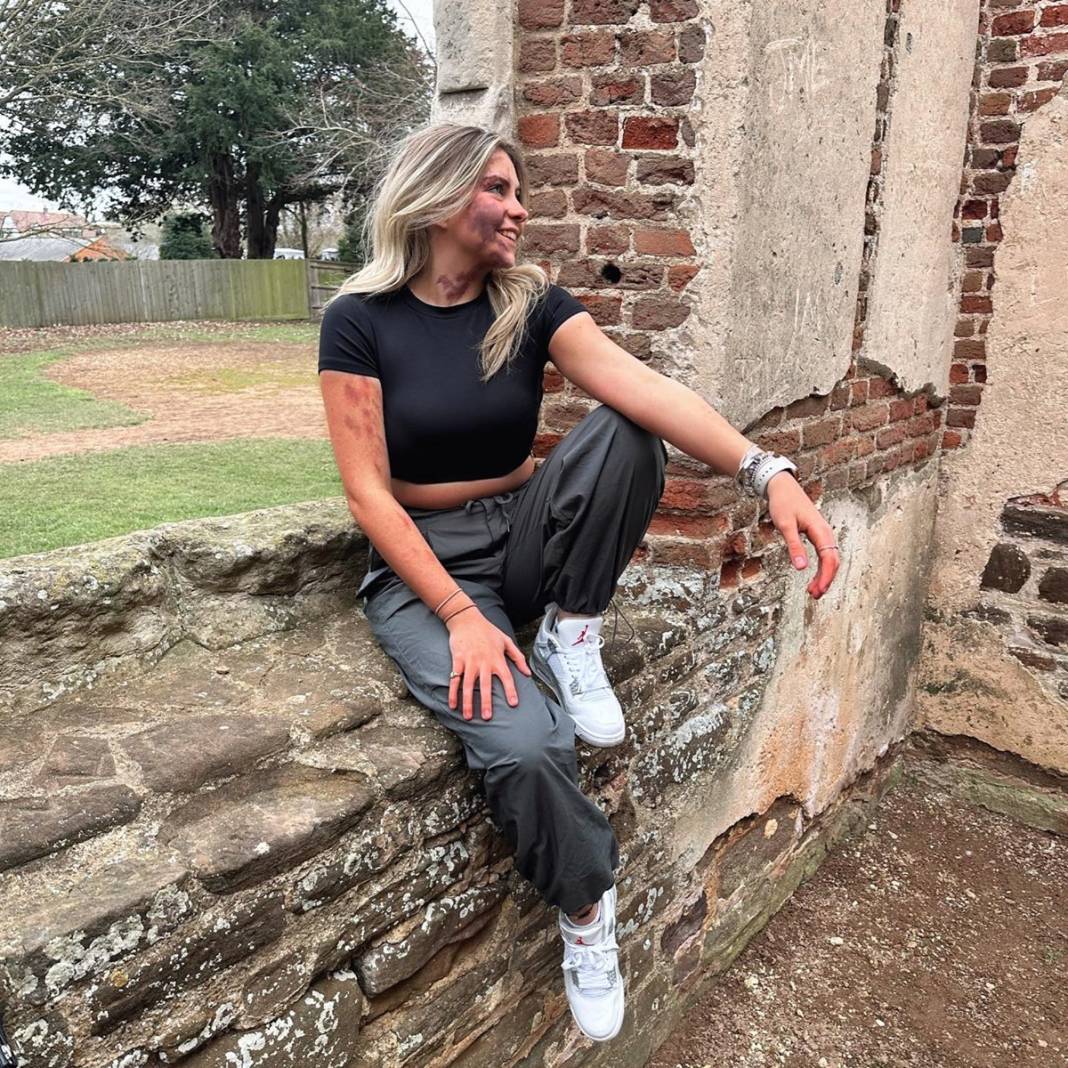 Basit bir uçuk zannetti, korkunç hastalığa yakalandı! Doktorlar bile teşhis koyamadı 17